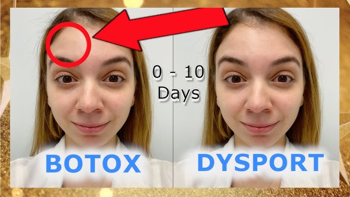 Dysport-vs-Botox.jpg