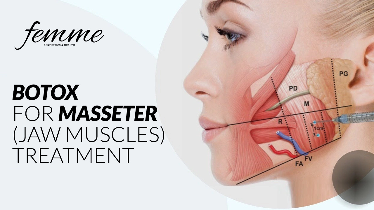botox-masseter_.webp