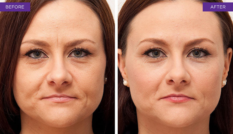 botox-stirn.jpg