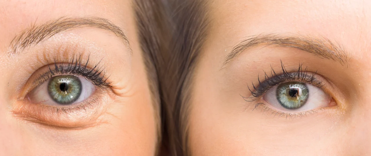 botox-under-eyes-1280x538.webp