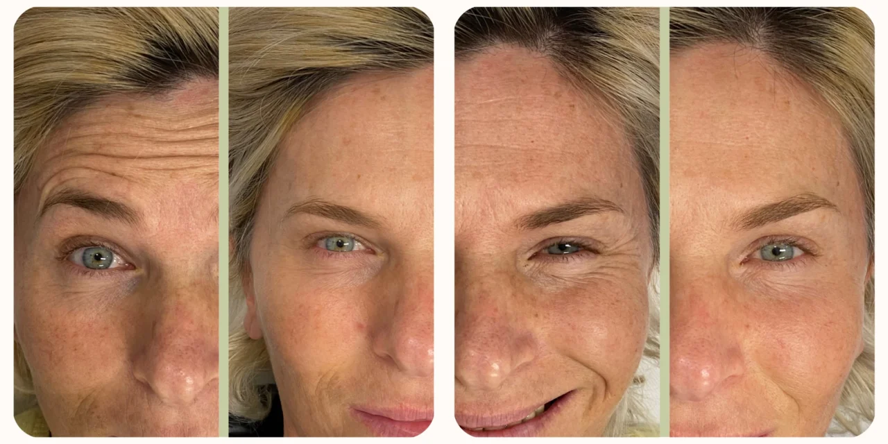 botox-viso-1280x640.webp
