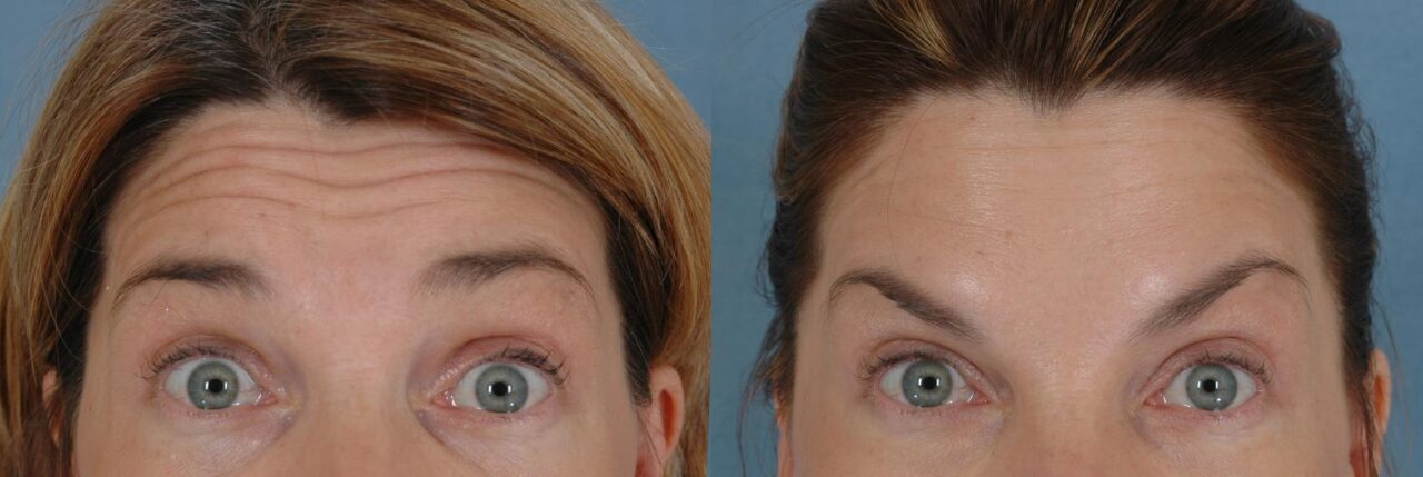 how-long-does-botox-take-to-work-1280x429.jpg