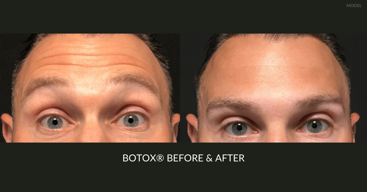 how-many-units-of-botox-for-forehead_.png