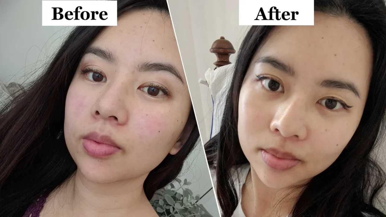 masseter-botox-before-and-after-1280x720.webp
