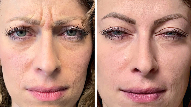 VN_Botox_Valentina-Manco-1.jpeg