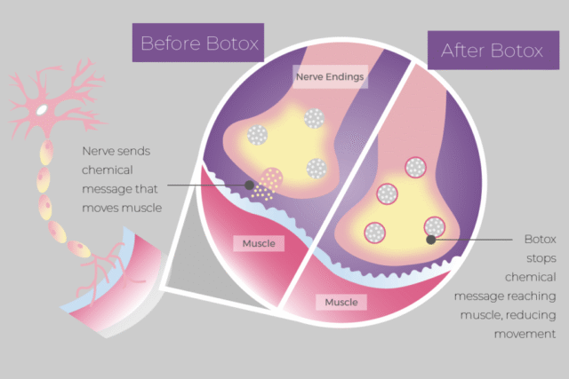 botox vorher nachher​