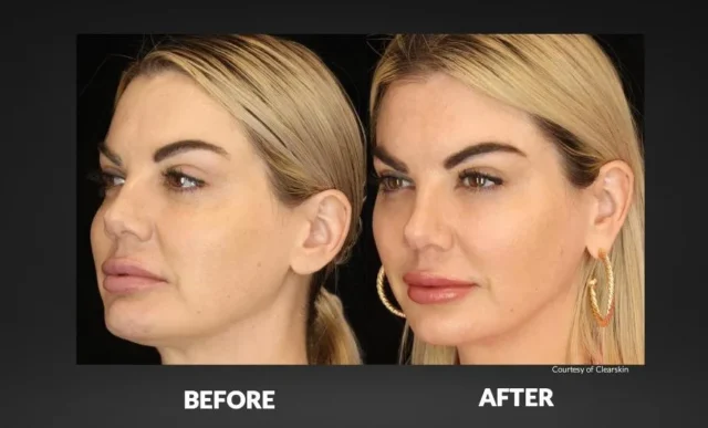 botox vorher nachher​
