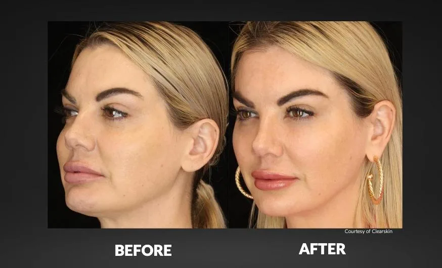 botox vorher nachher​