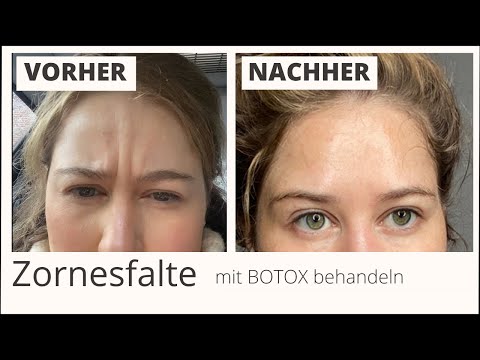 botox-zornesfalte.jpg