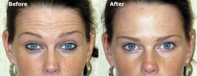 Common Botox Treatments and Their Results