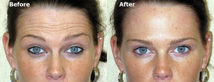 Common Botox Treatments and Their Results