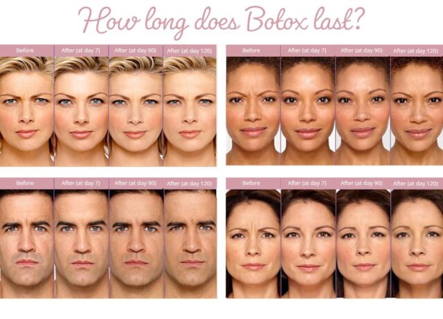 botox vorher nachher​