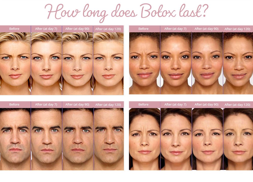 botox vorher nachher​