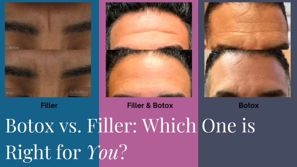 is-botox-a-dermal-filler_.webp