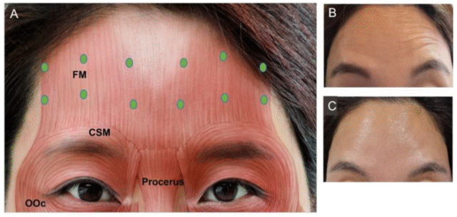Botox vs Dysport vs Azzalure